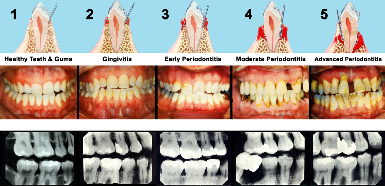 Sunnyvale Dentist - Periodontal Disease